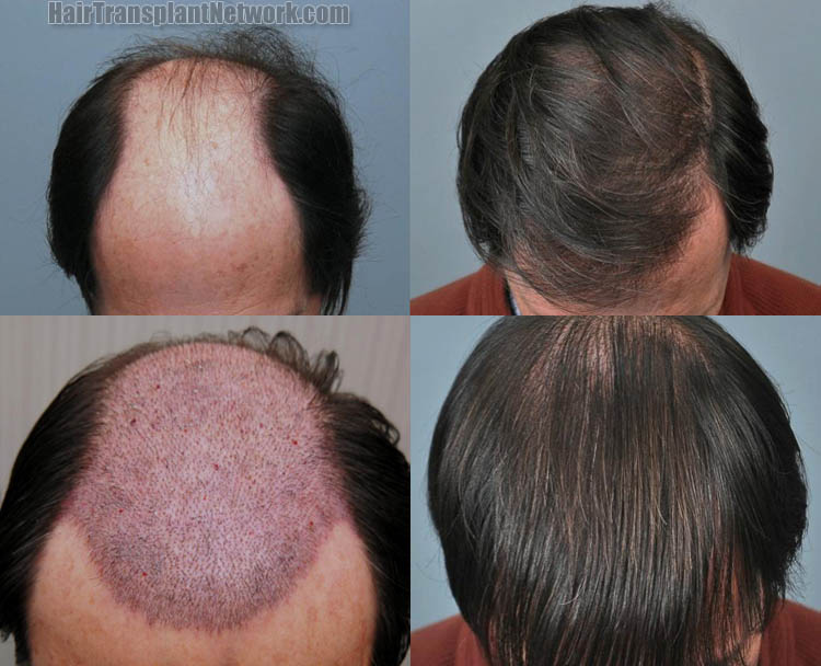 regrow lost hair naturally 15 minutes day